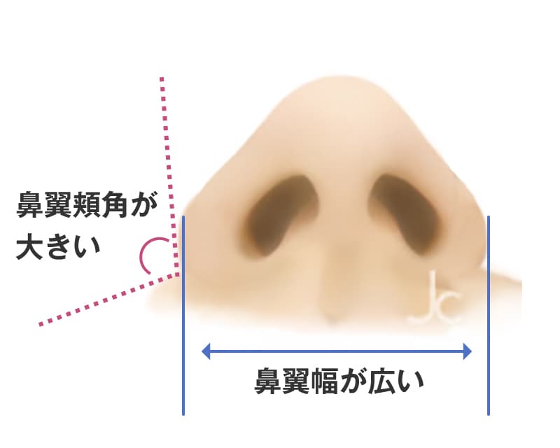 鼻幅のバランスの解説イラスト。鼻翼頬角が大きく、鼻翼幅が広い