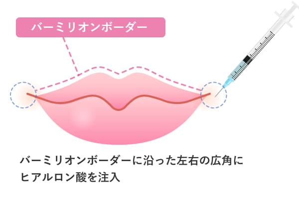 バーミリオンボーダーに沿ってヒアルロン酸を注入してアヒル口にすることを解説したイラスト