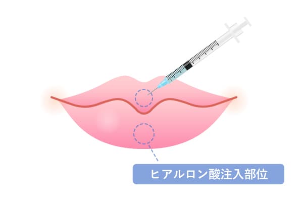 上唇・下唇にヒアルロン酸を注入し、全体的にボリュームアップさせることを解説したイラスト