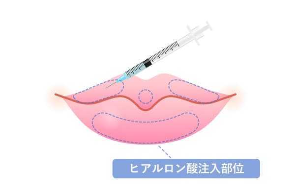 上唇・下唇にそれぞれにヒアルロン酸を注入してM字リップにさせることを解説したイラスト