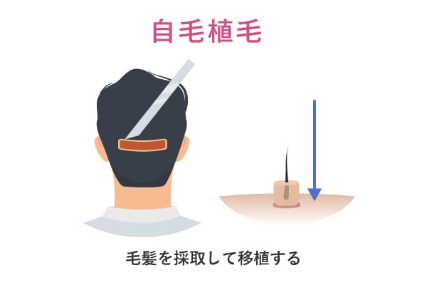 自毛植毛のイメージイラスト