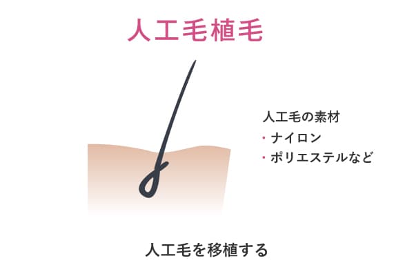 人工毛植毛のイメージイラスト