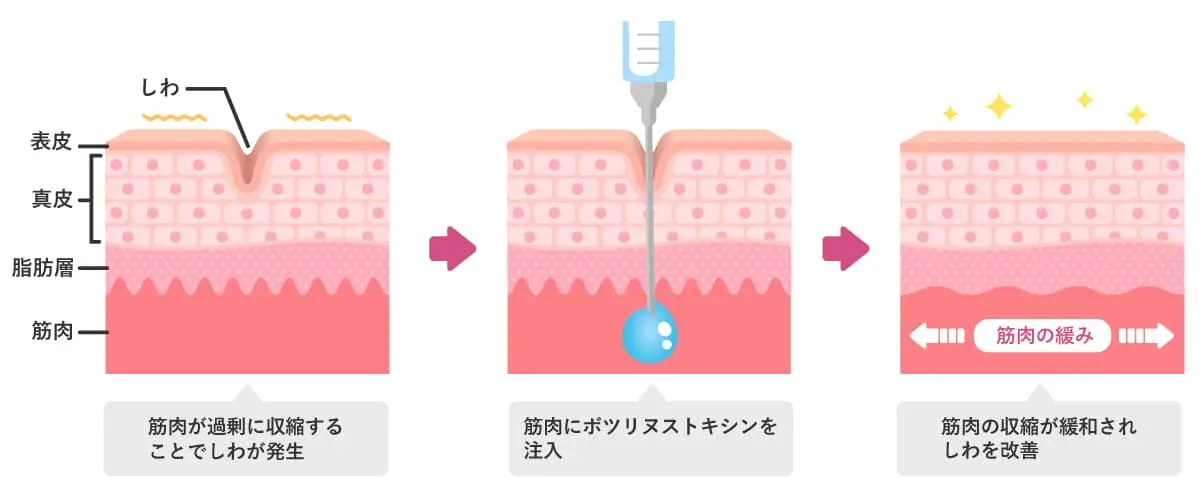 ボトックス注射の作用と効果の解説イラスト