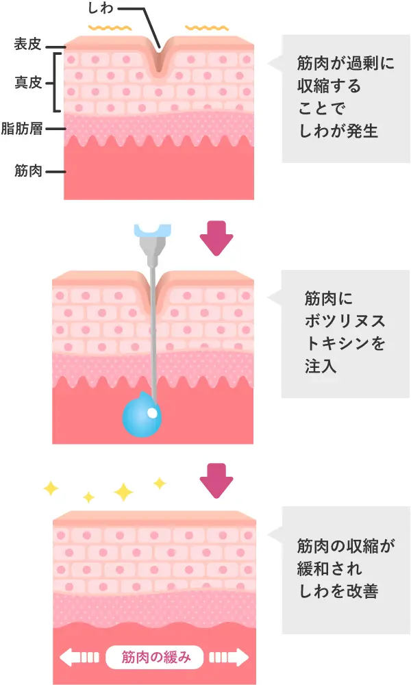 ボトックス注射の作用と効果の解説イラスト