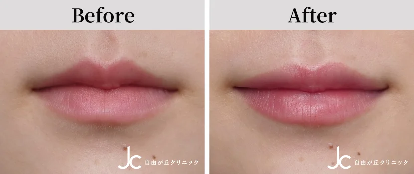 唇のヒアルロン酸注入の症例写真