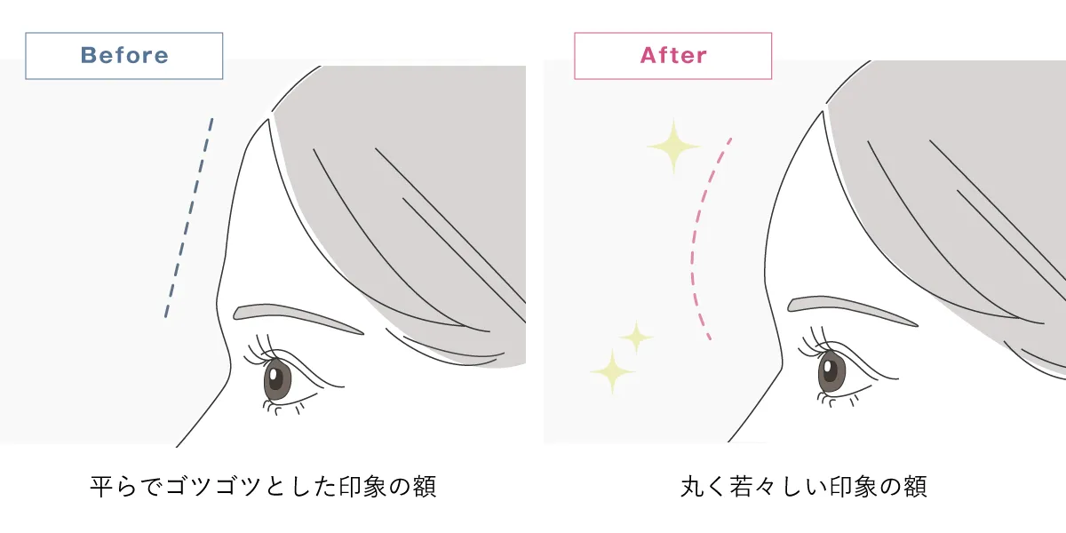 平でゴツゴツした額にヒアルロン酸を注入し、丸くて若々しい印象の額になることを解説したイラスト