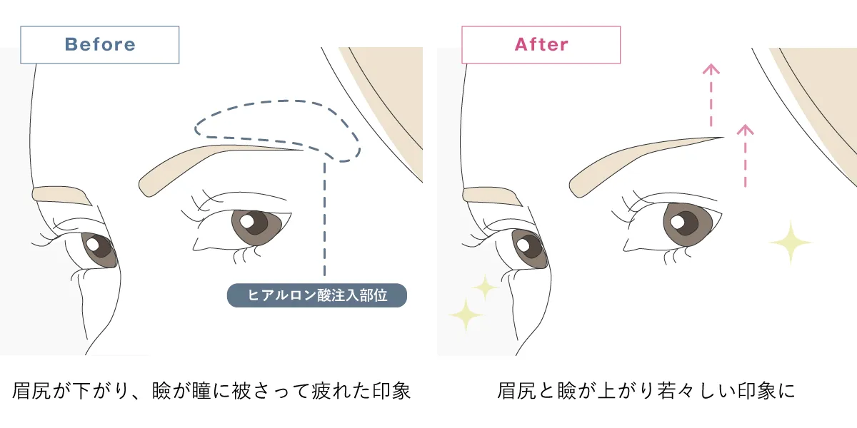 眉上にヒアルロン酸を注入することで、眉尻と目尻が上がり若々し印象になることを解説したイラスト