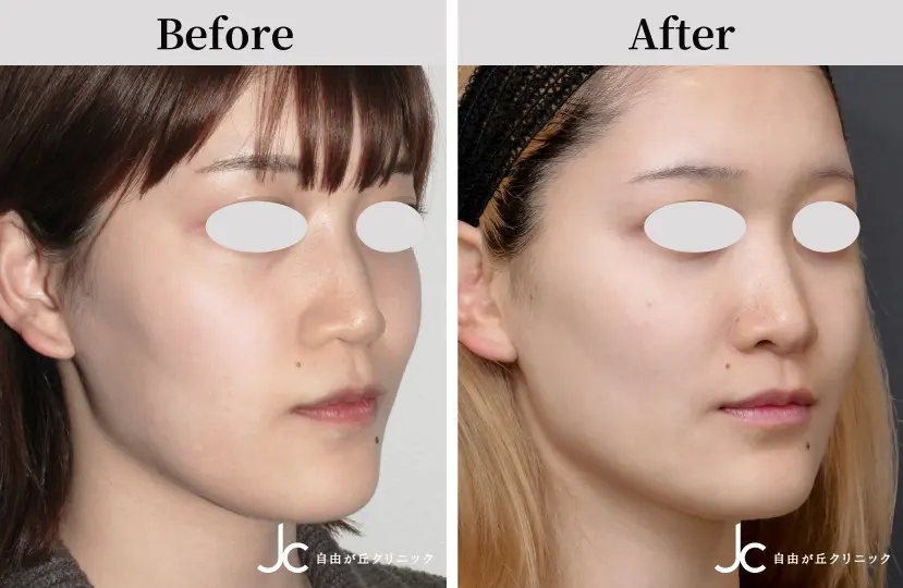 鼻の手術の症例写真