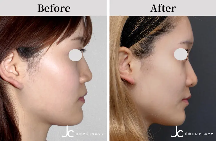 鼻の手術の症例写真