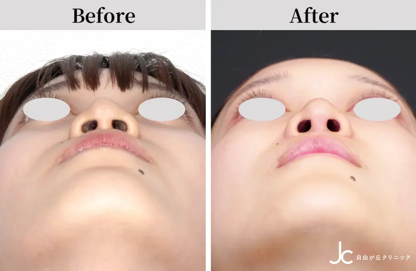 鼻の手術の症例写真