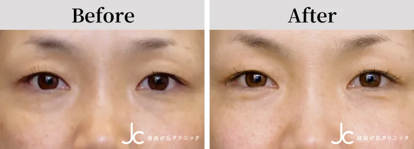 プルリアル デンシファイの症例写真