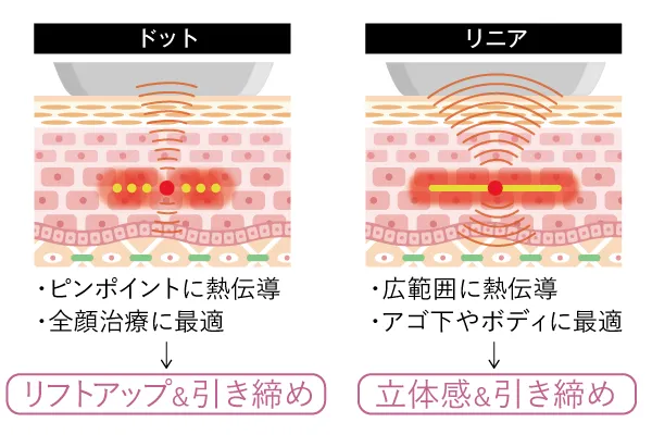 ウルトラセルZi　ドット照射とリニア照射の図解