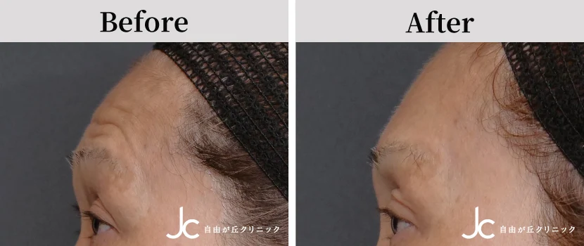 額のヒアルロン酸の症例写真