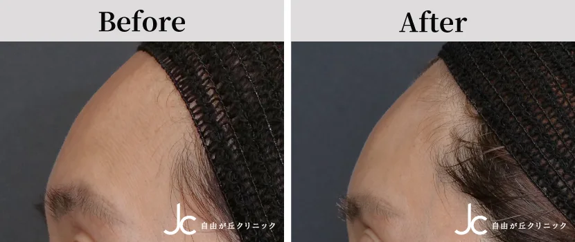 額のヒアルロン酸の症例写真