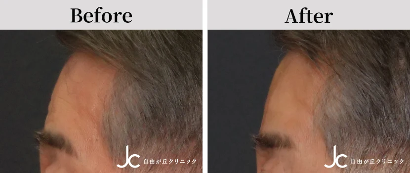 額のヒアルロン酸の症例写真