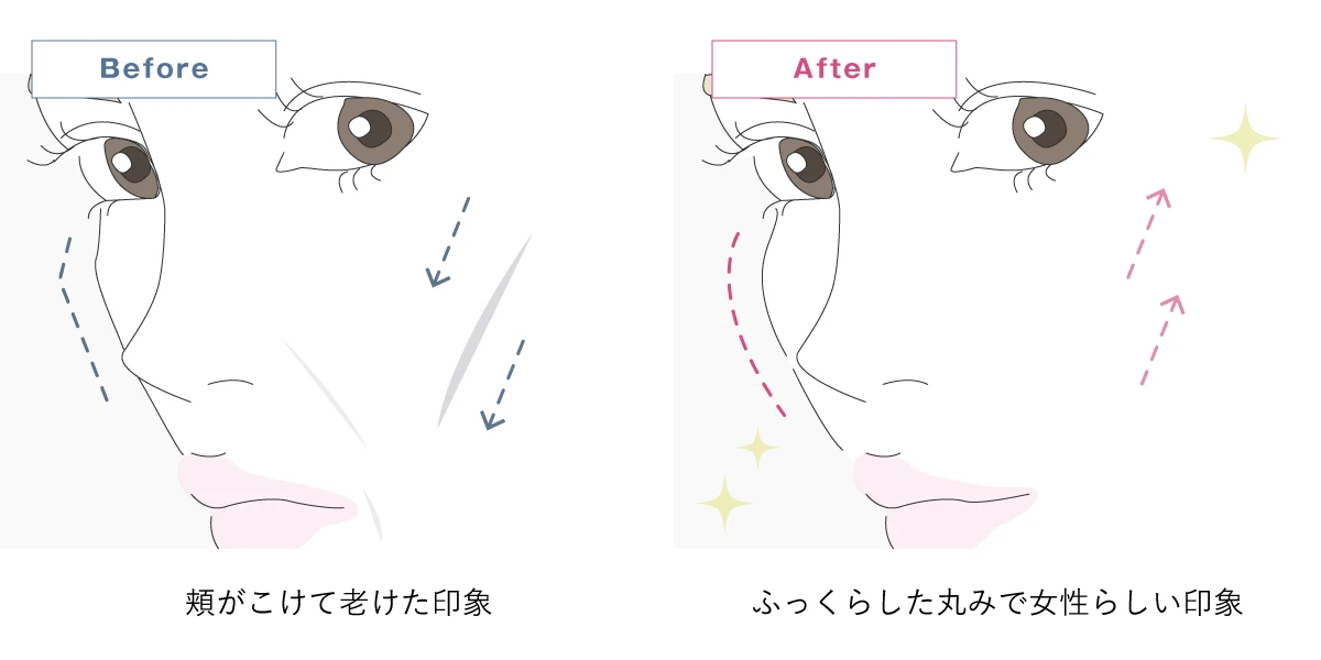 頬のヒアルロン酸注射のイメージイラスト