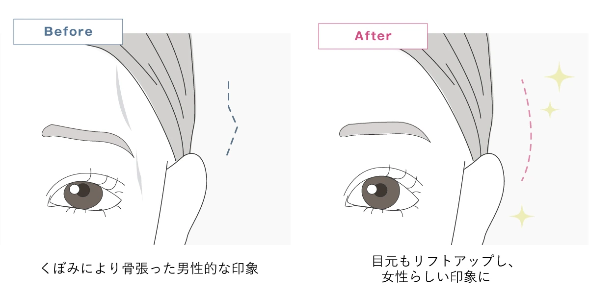 こめかみのヒアルロン酸注射のイメージイラスト