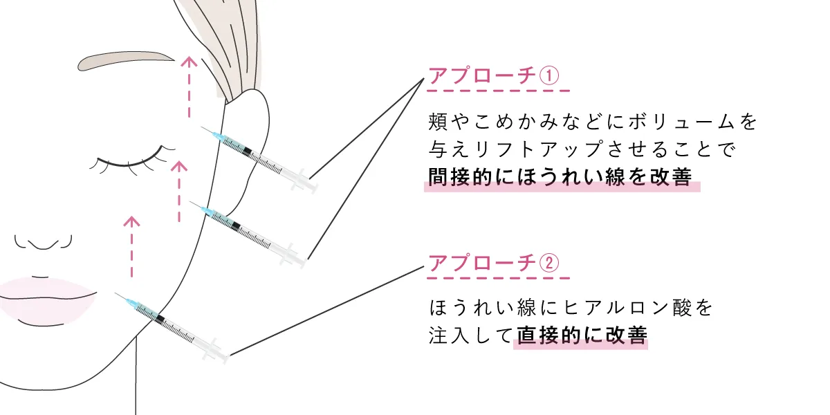 ほうれい線のヒアルロン酸注射の方法