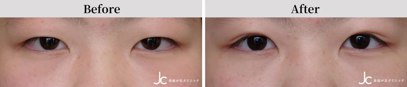 二重（埋没）の症例写真
