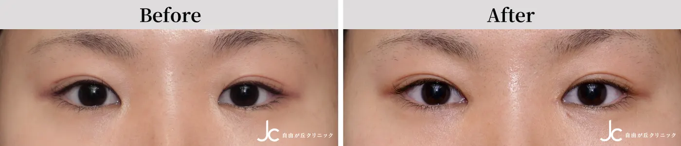 目頭切開の症例写真