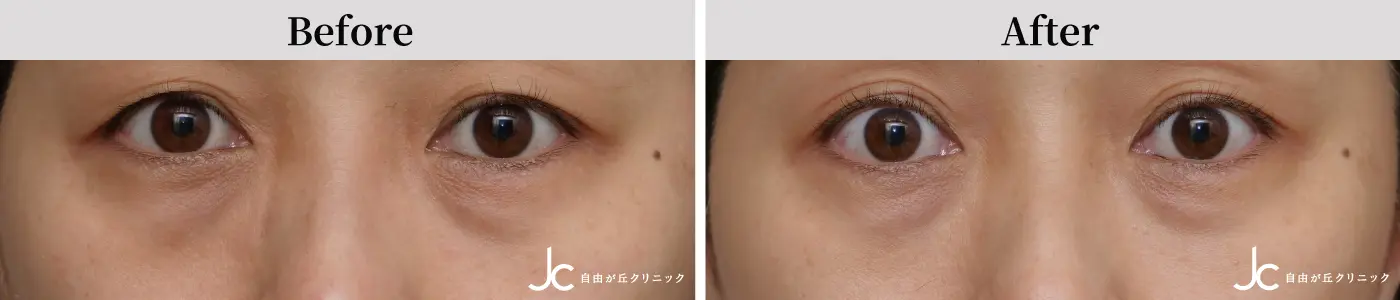 NCTF症例・目元