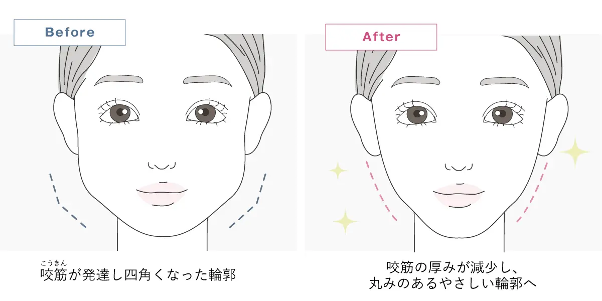 エラボトックスの効果イメージイラスト