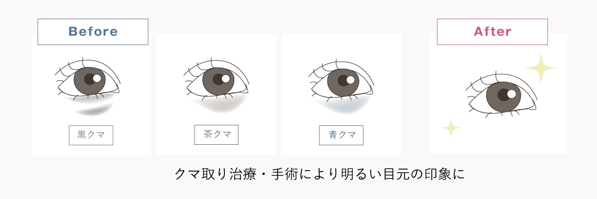 クマ取りの解説イラスト