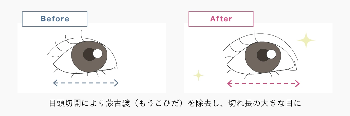 目頭切開のイメージイラスト