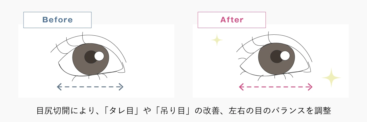 目尻切開のイメージイラスト