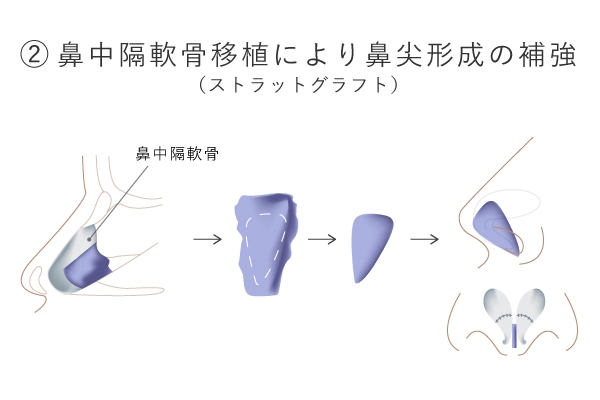 鼻中隔軟骨移植のイメージ画像