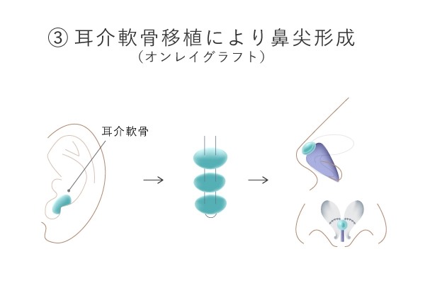 耳介軟骨移植のイメージ画像