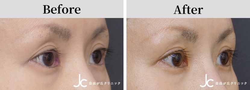 眼瞼下垂の症例写真