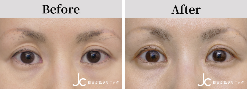 眼瞼下垂の症例写真