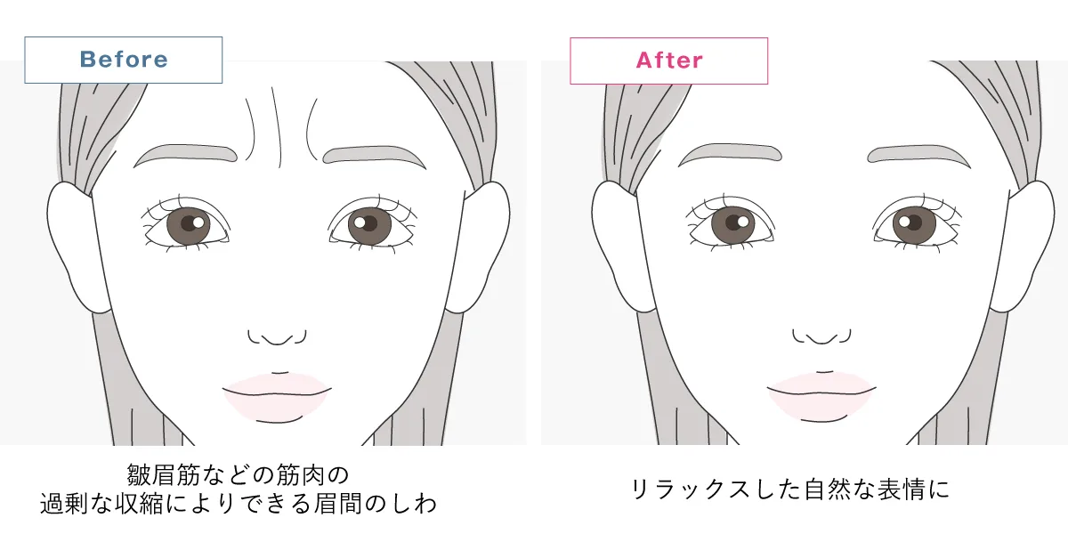 眉間のボトックスの効果解説イラスト