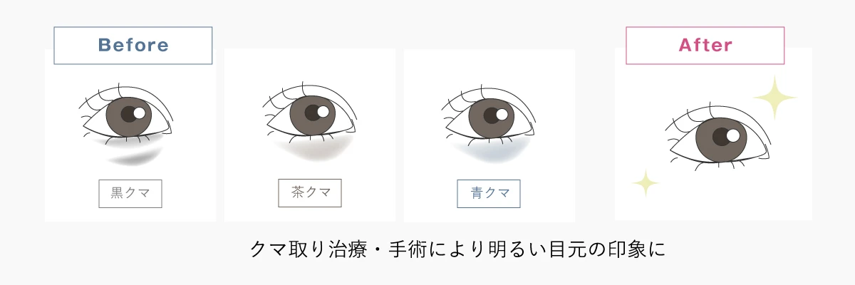 目の下のクマ・たるみ取りの解説イラスト