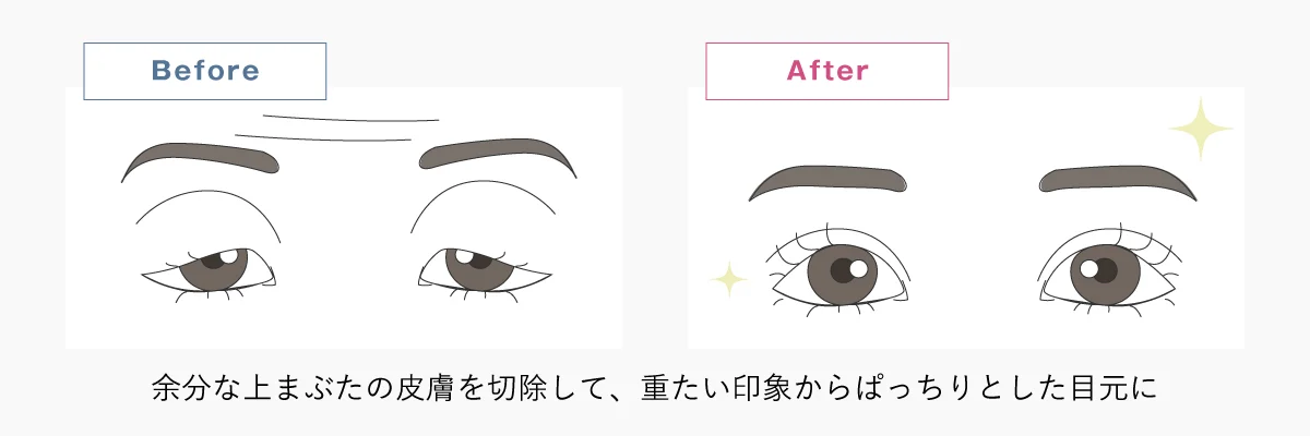 上まぶたのたるみ取りの解説イラスト