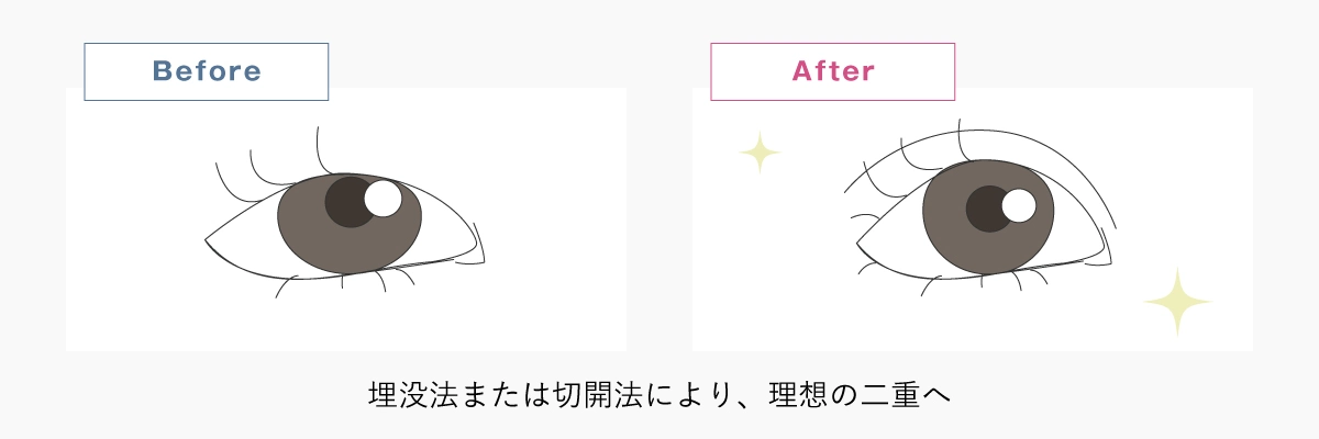 二重の手術のイメージイラスト
