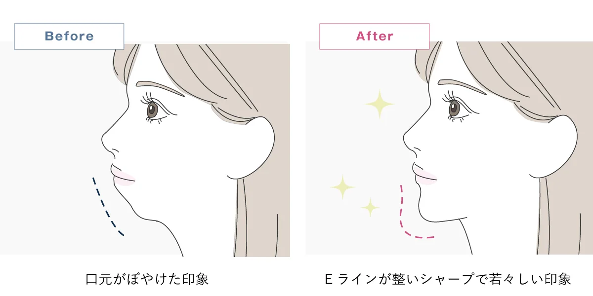 顎のヒアルロン酸注射の効果解説イラスト