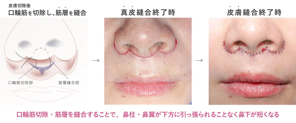 口輪筋切除・筋層を縫合することで、鼻柱・鼻翼が下方に引っ張られることなく鼻下が短くなる