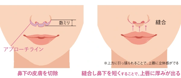 リップリフトの仕組みのイラスト。鼻下の皮膚を切除・縫合し鼻下を短くすることで、上唇に厚みが出る