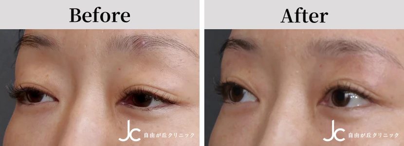 上まぶたのたるみとりの症例写真