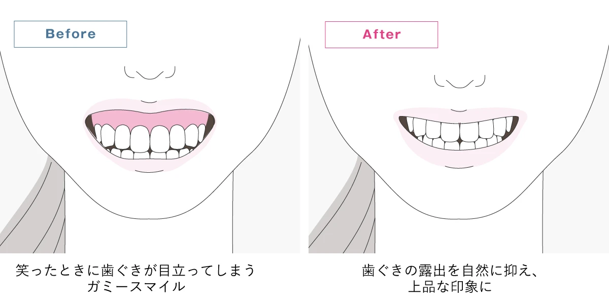 ガミースマイルの効果解説イラスト