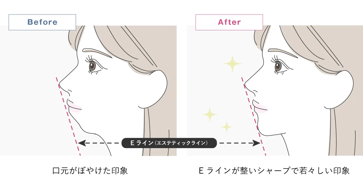 顎のヒアルロン酸注射の効果解説イラスト