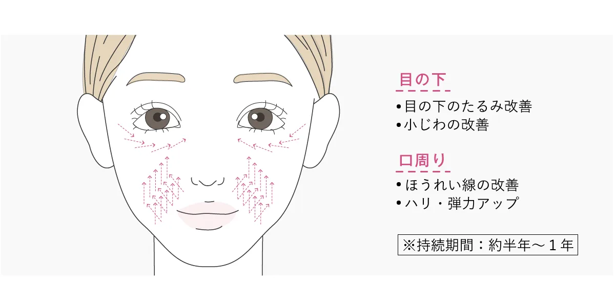 独自の挿入法イメージ画像