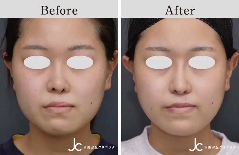 口唇裂の症例写真