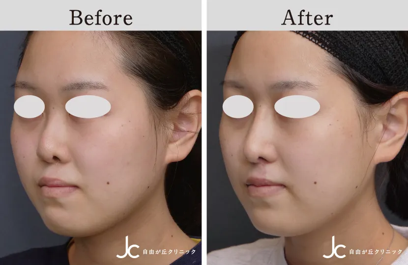 口唇裂の症例写真