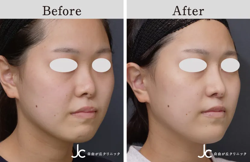 口唇裂の症例写真