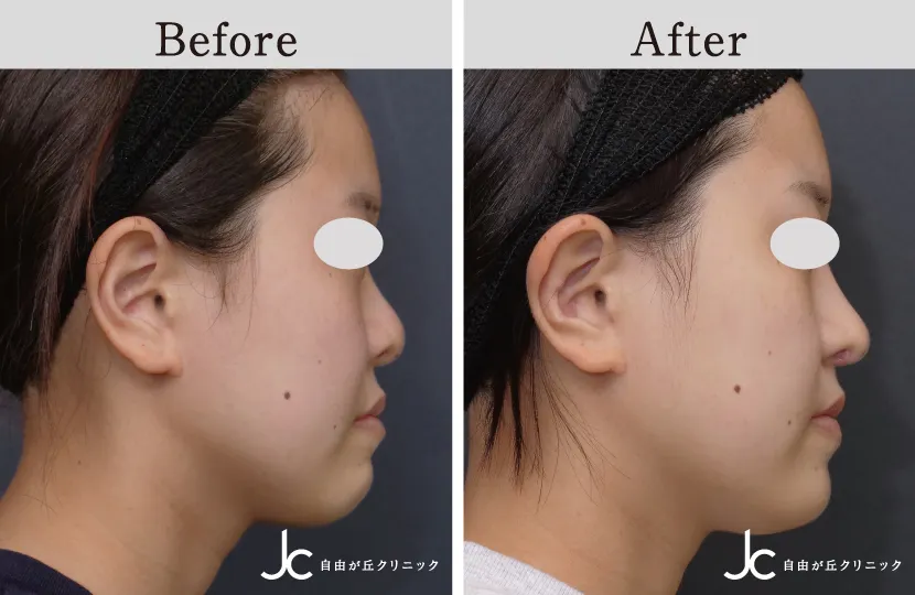 口唇裂の症例写真