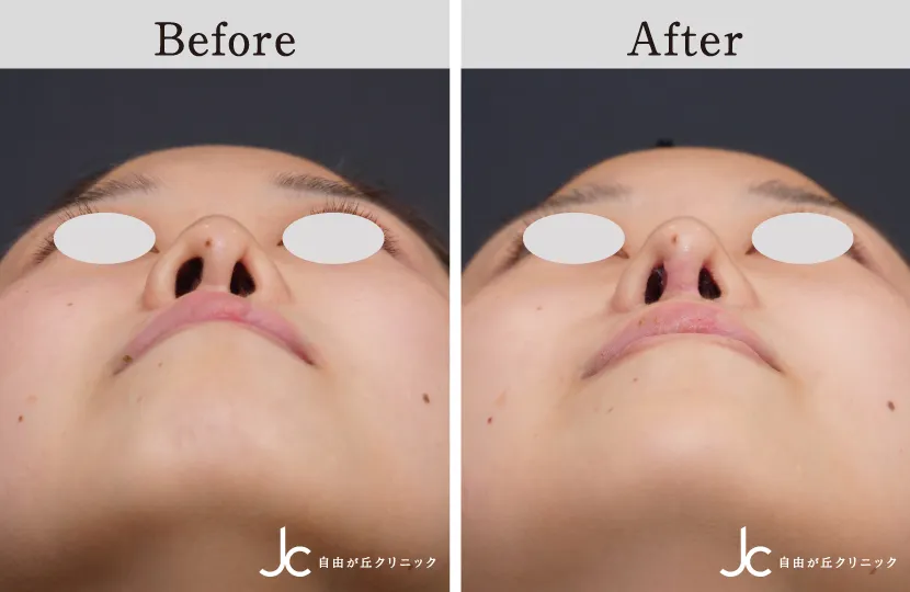 口唇裂術後の修正手術・併用治療なら自由が丘クリニック【公式】