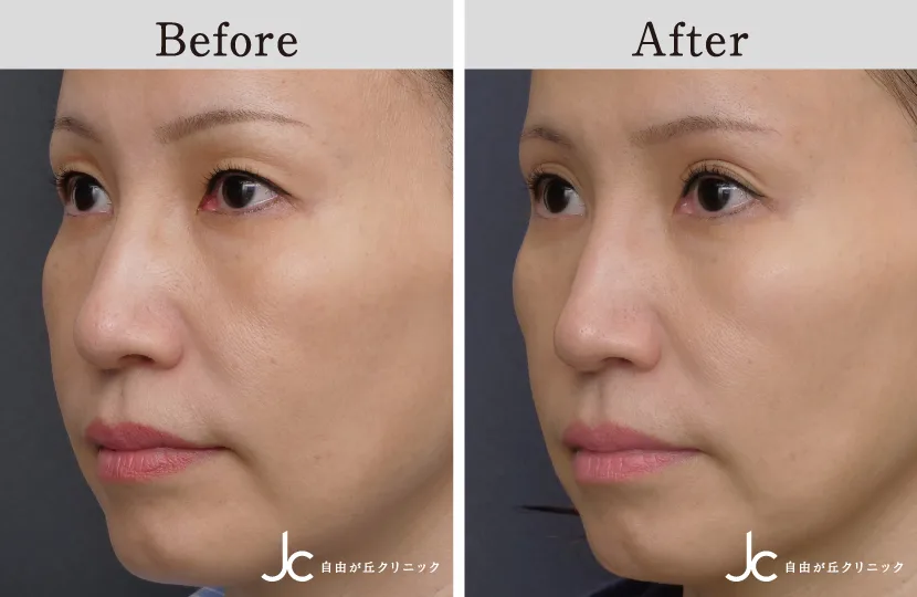 上まぶたのたるみ取りの症例写真